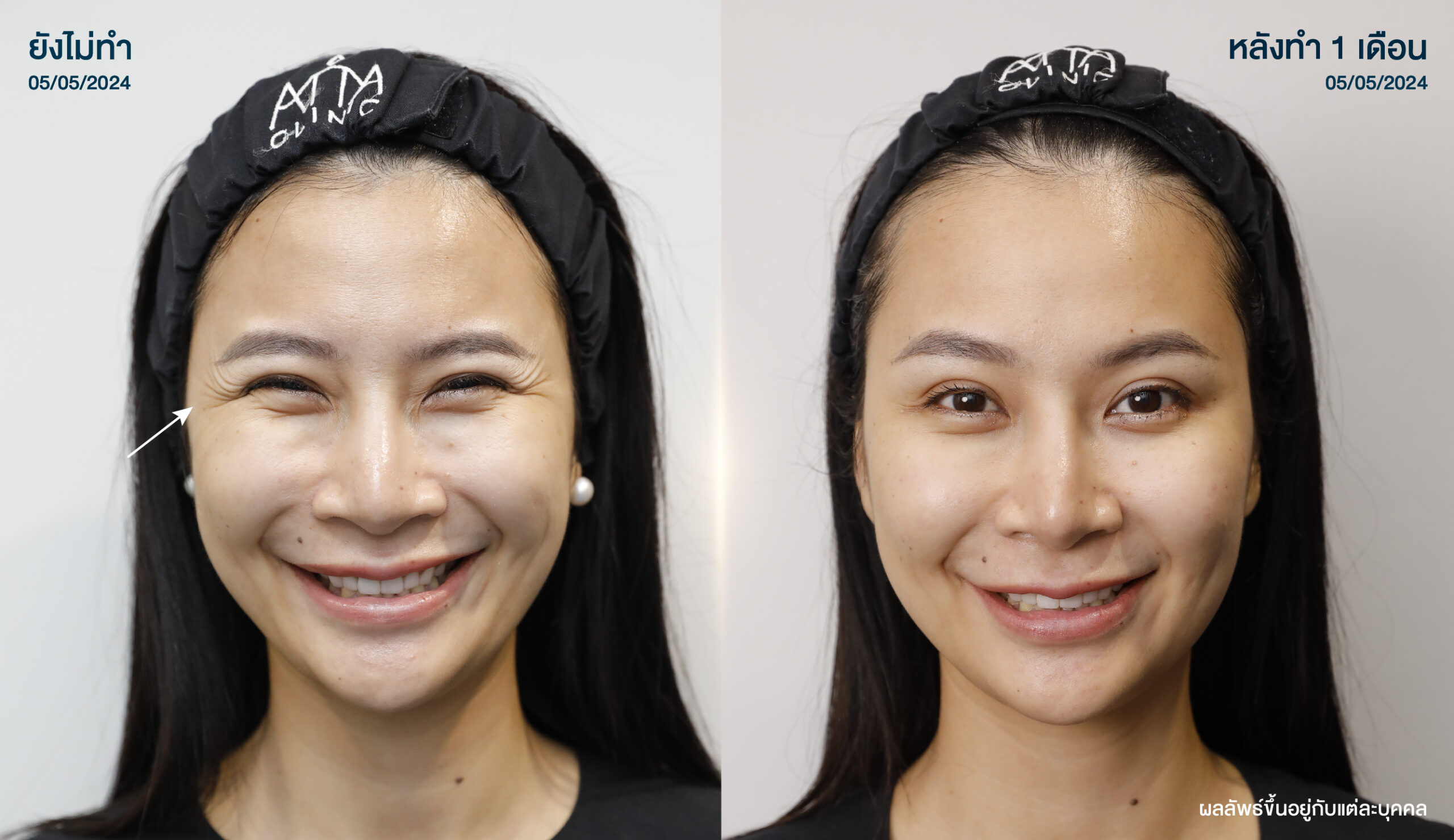 ATTA_BEFORE_AFTER_BANNER_1280x740PX-04