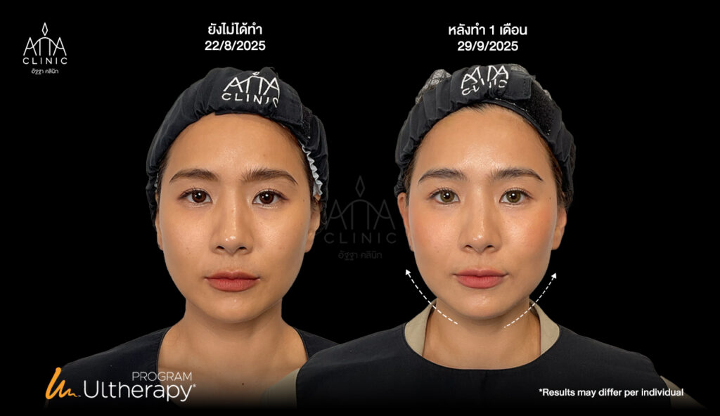 รีวิวก่อนหลังทำโปรแกรม ULTHERAPY