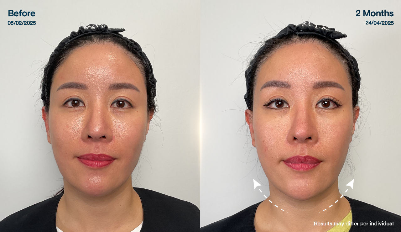 ATTA_BEFORE_AFTER_BANNER_12 80x740PX ver Eng-12