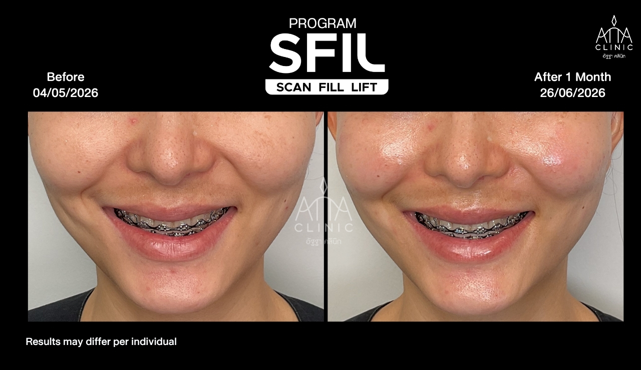 รีวิวฉีดฟิลเลอร์ด้วยเทคนิคอัลตราซาวนด์นำทาง โปรแกรม SFIL เปรียบเทียบรอยยิ้มก่อนและหลังทำ