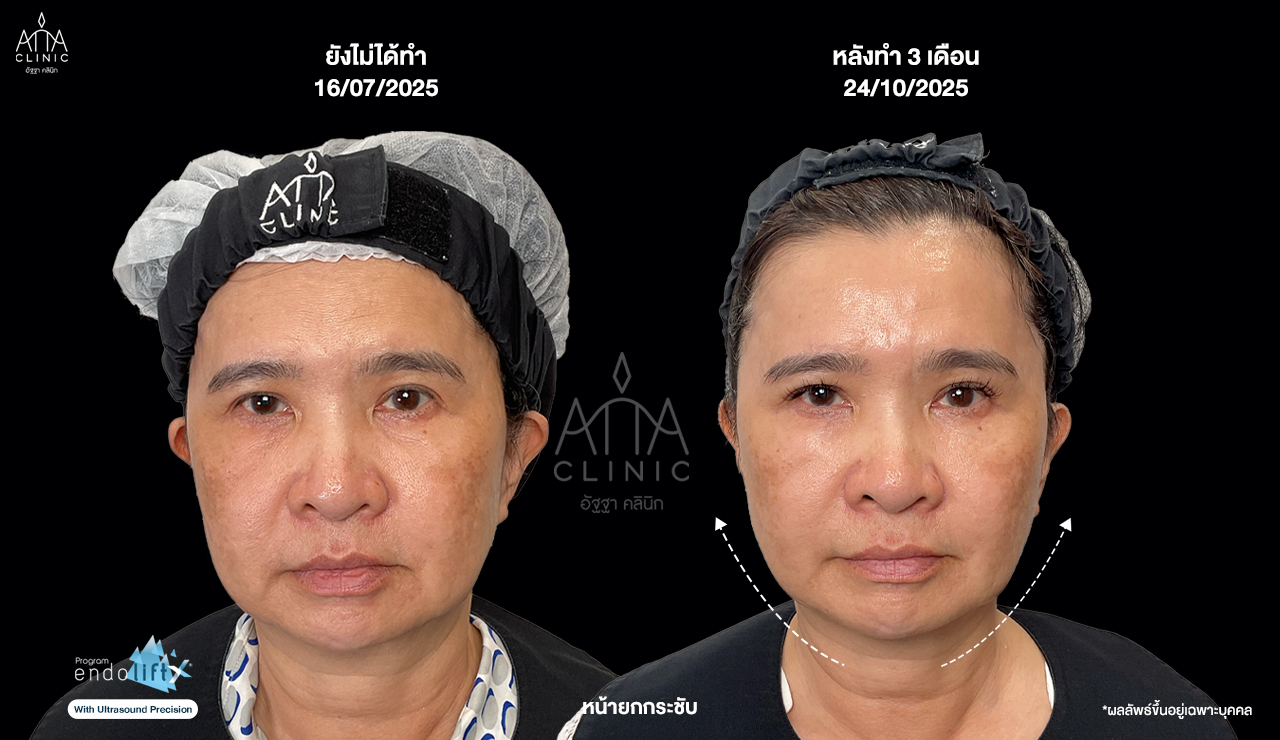ผลลัพธ์โปรแกรม Endolift 3 เดือน