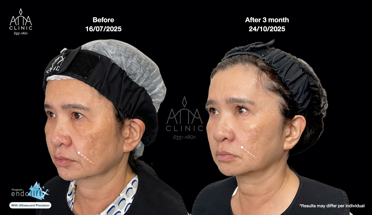 ผลลัพธ์โปรแกรม Endolift 3 เดือน