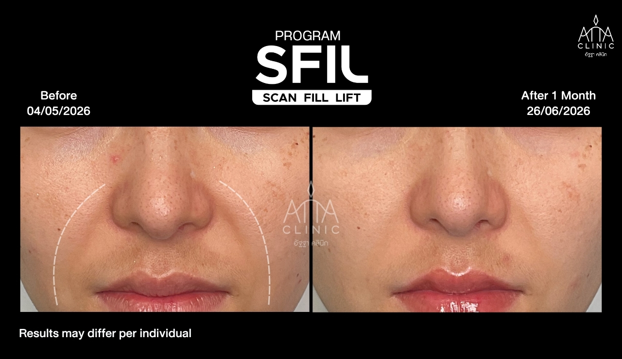 รีวิวฟิลเลอร์ SFIL ก่อนและหลังทำ เปรียบเทียบบริเวณร่องแก้มจากมุมตรง