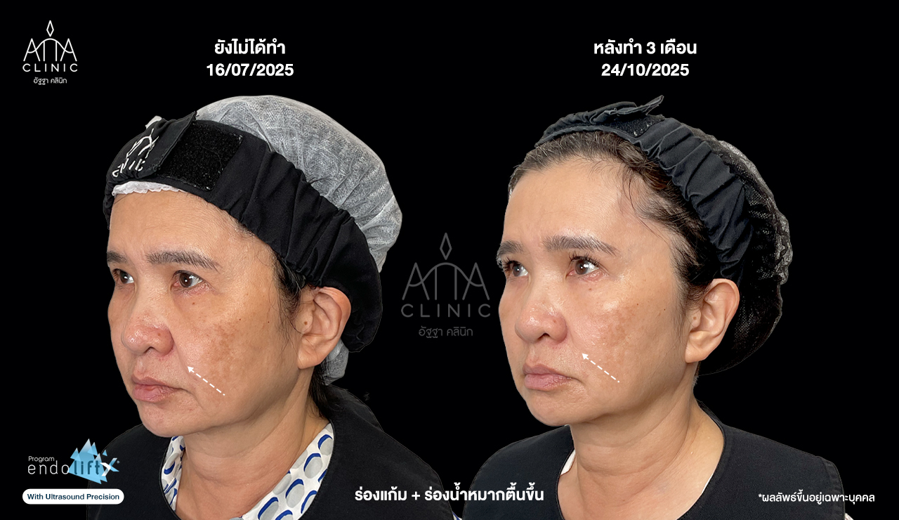 ผลลัพธ์โปรแกรม Endolift 3 เดือน