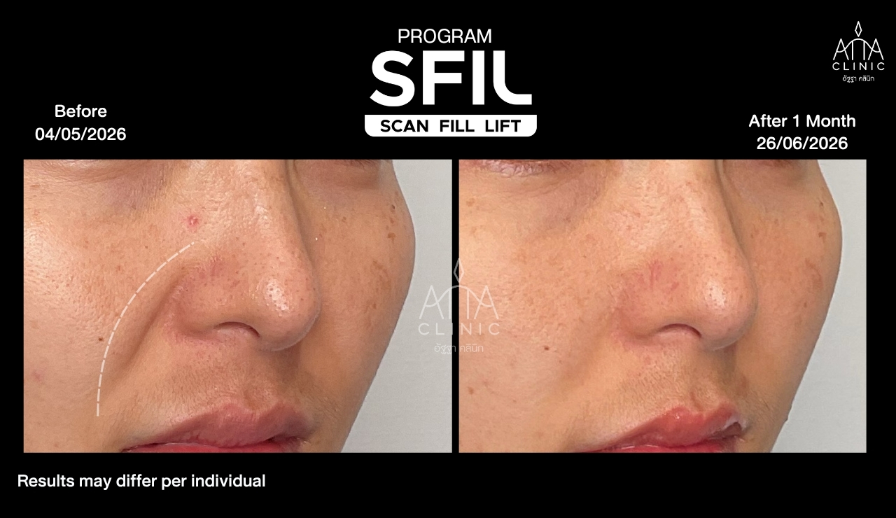 รีวิวฉีดฟิลเลอร์โปรแกรม SFIL เปรียบเทียบบริเวณข้างจมูกและร่องแก้มจากมุมเฉียง