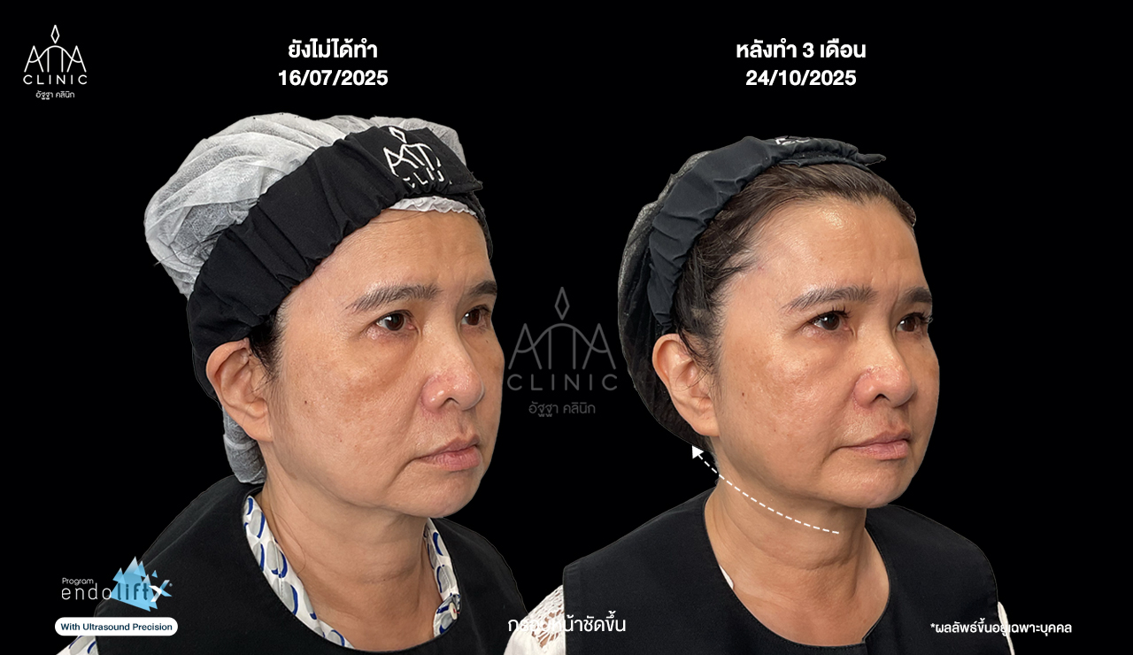 ผลลัพธ์โปรแกรม Endolift 3 เดือน