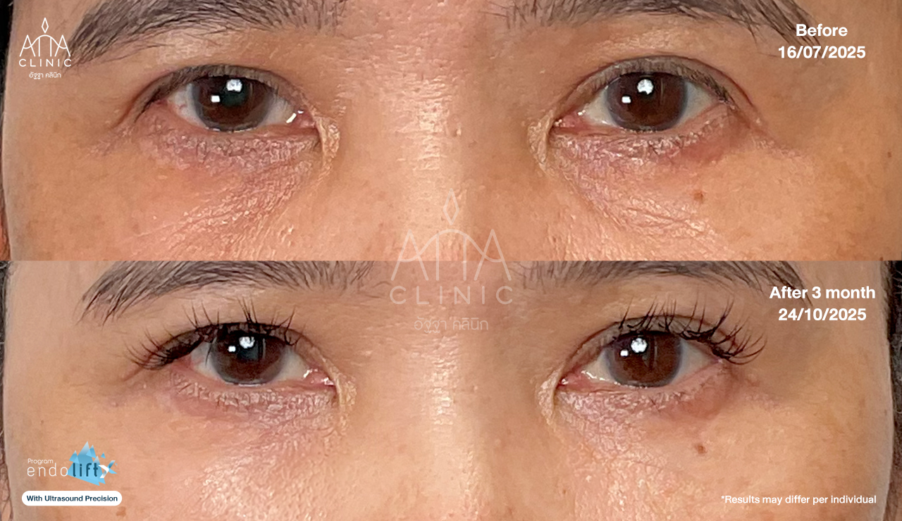 ผลลัพธ์โปรแกรม Endolift 3 เดือน