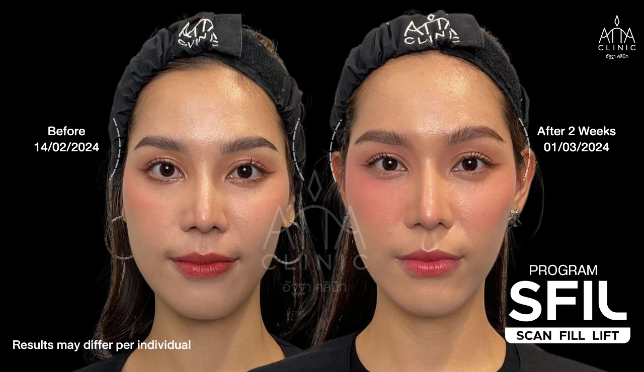 รีวิวฉีดฟิลเลอร์ปรับรูปหน้า โปรแกรม SFIL ก่อนและหลังทำ 2 สัปดาห์ เปรียบเทียบใบหน้ามุมตรง