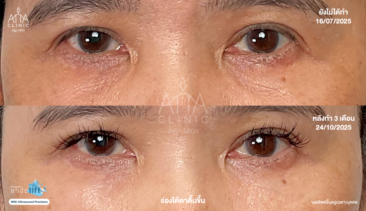 ผลลัพธ์โปรแกรม Endolift 3 เดือน