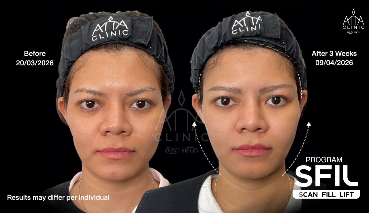 รีวิวฉีดฟิลเลอร์ด้วยเทคนิคอัลตราซาวนด์นำทาง โปรแกรม SFIL ก่อนและหลังทำ 3 สัปดาห์ เปรียบเทียบใบหน้าและกรอบหน้ามุมตรง