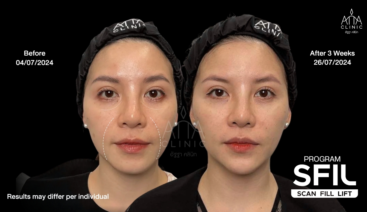 รีวิวฉีดฟิลเลอร์ปรับรูปหน้า โปรแกรม SFIL ก่อนและหลังทำ 3 สัปดาห์ เปรียบเทียบบริเวณใต้ตา ร่องแก้ม และใบหน้ามุมตรงที่ ATTA Clinic