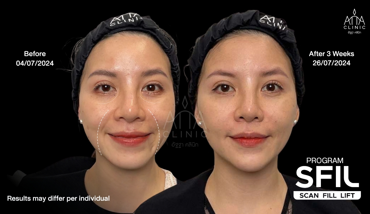 รีวิวฉีดฟิลเลอร์ โปรแกรม SFIL ก่อนและหลังทำ 3 สัปดาห์ เปรียบเทียบบริเวณร่องแก้มและแก้มขณะยิ้มที่ ATTA Clinic
