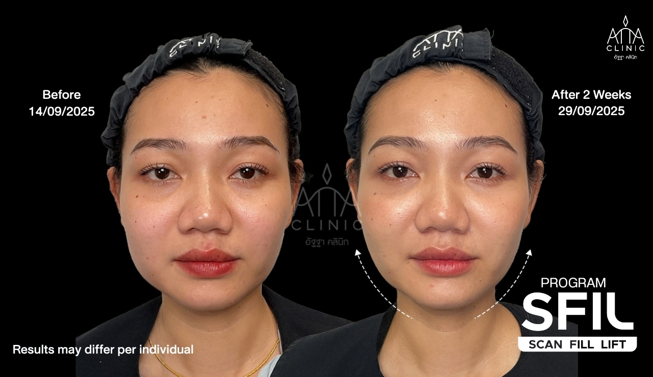 รีวิวฟิลเลอร์ยกกระชับหน้า โปรแกรม SFIL ก่อนและหลังทำ 2 สัปดาห์ เปรียบเทียบรูปหน้ามุมตรงที่ ATTA Clinic