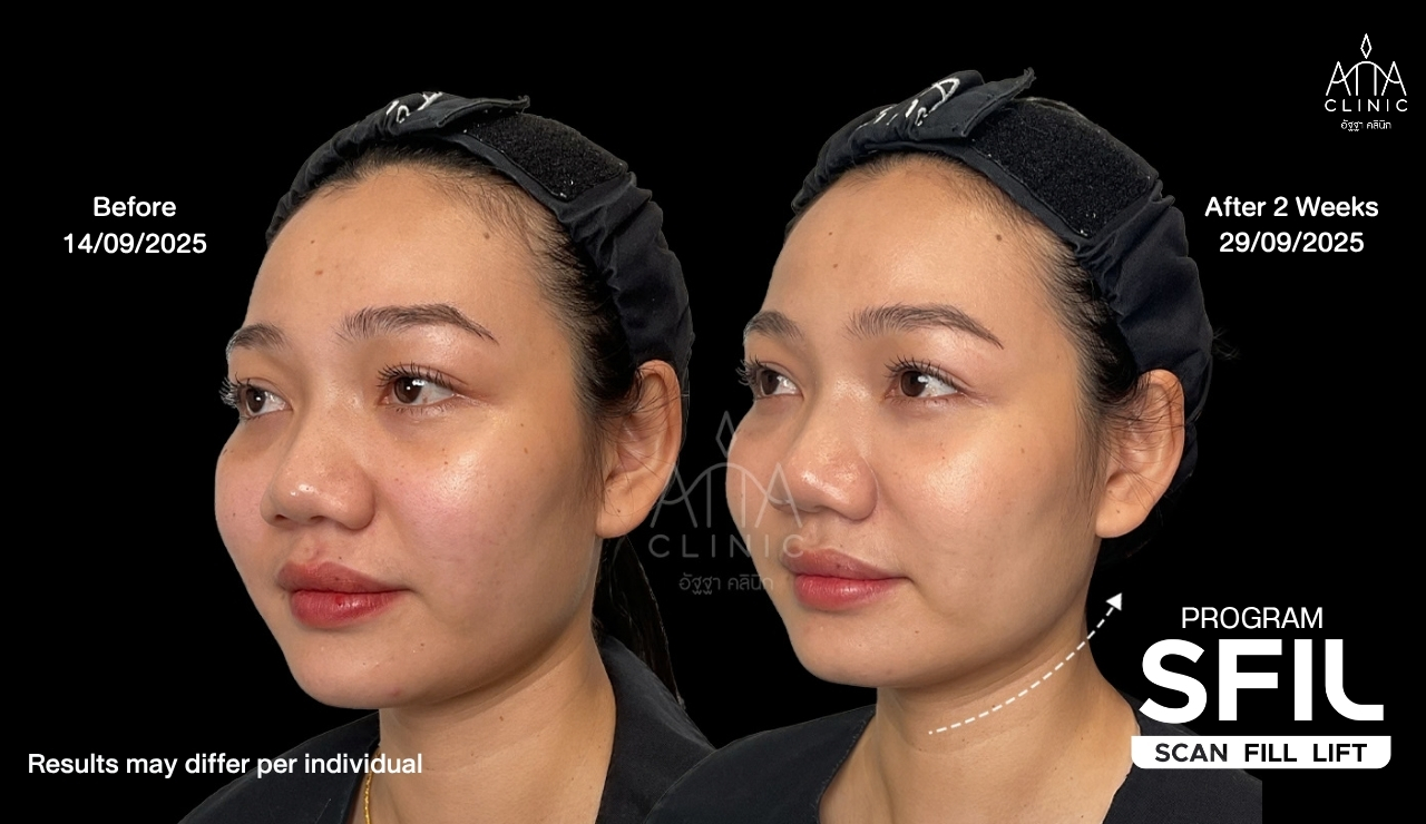 รีวิวฉีดฟิลเลอร์ปรับรูปหน้าและยกกระชับ โปรแกรม SFIL เปรียบเทียบใบหน้ามุมเฉียงก่อนและหลังทำ 2 สัปดาห์