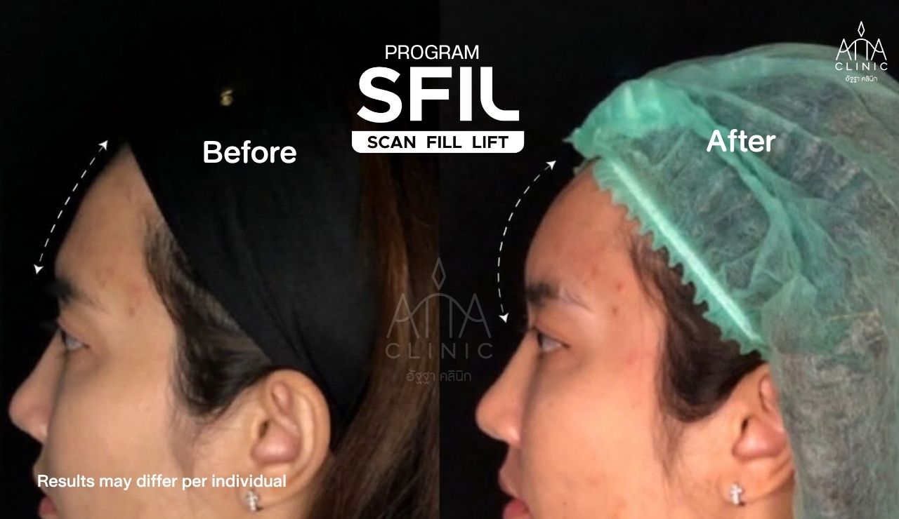 รีวิวฉีดฟิลเลอร์โปรแกรม SFIL ก่อนและหลังทำ เปรียบเทียบรูปทรงหน้าผากจากมุมด้านข้างที่ ATTA Clinic