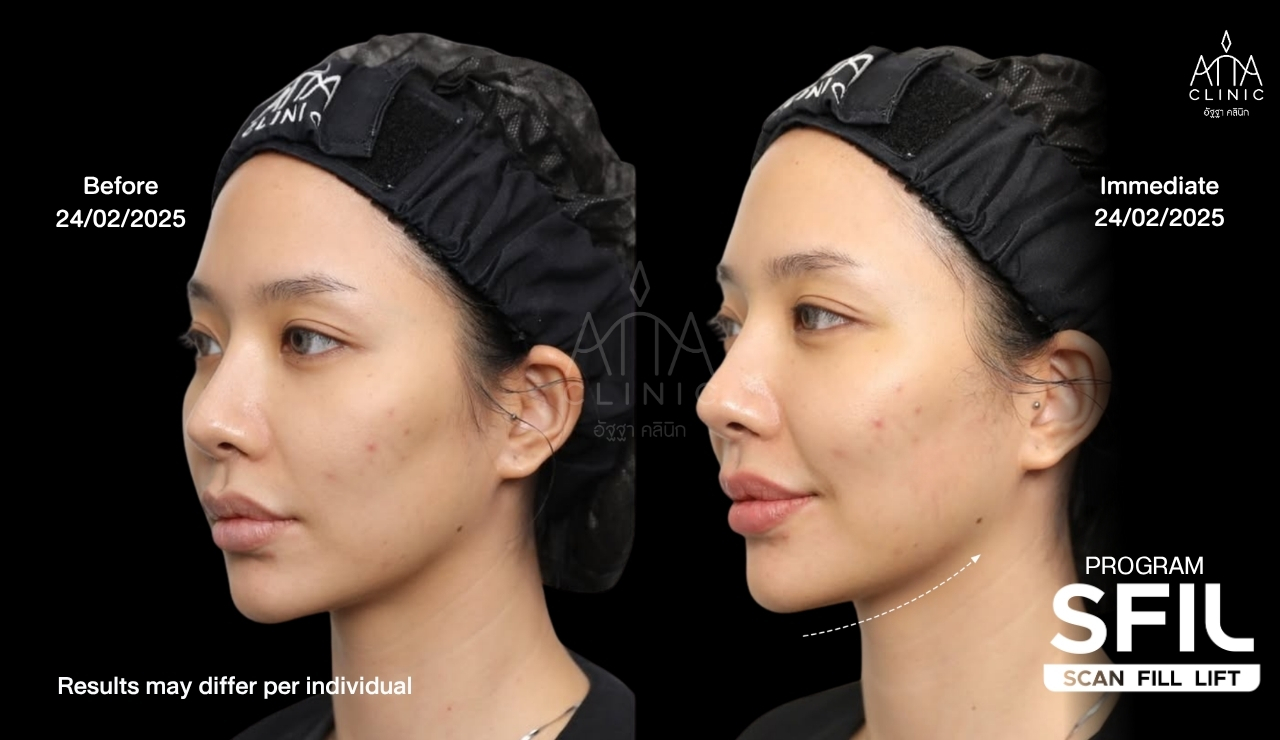 รีวิวฉีดฟิลเลอร์ปรับรูปหน้า โปรแกรม SFIL ก่อนและหลังทำทันที เปรียบเทียบแก้มและกรอบหน้ามุมเฉียง