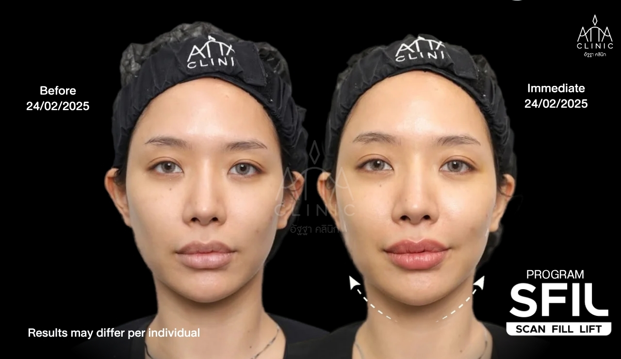 รีวิวฟิลเลอร์ยกกระชับหน้า โปรแกรม SFIL ก่อนและหลังทำทันที เปรียบเทียบรูปหน้าและกรอบหน้ามุมตรง