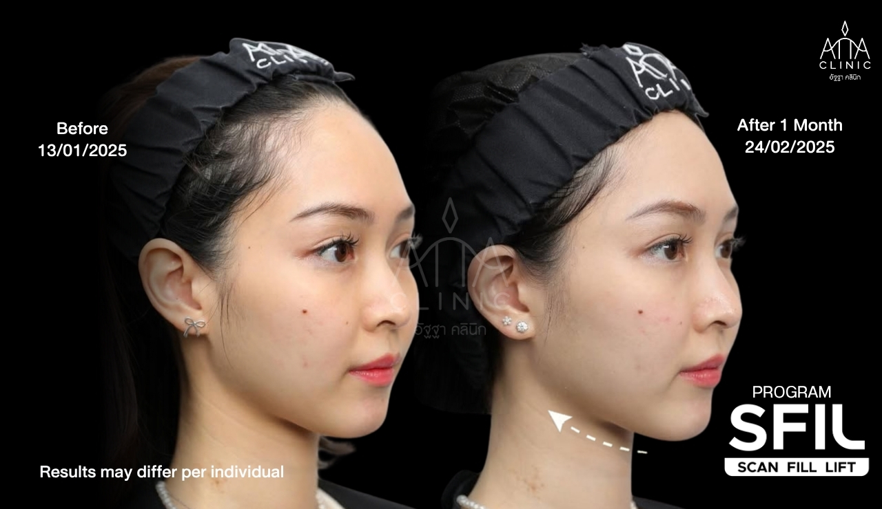 รีวิวฉีดฟิลเลอร์ปรับรูปหน้า ก่อนและหลังทำประมาณ 1 เดือน เปรียบเทียบแก้มและแนวกรอบหน้ามุมเฉียง