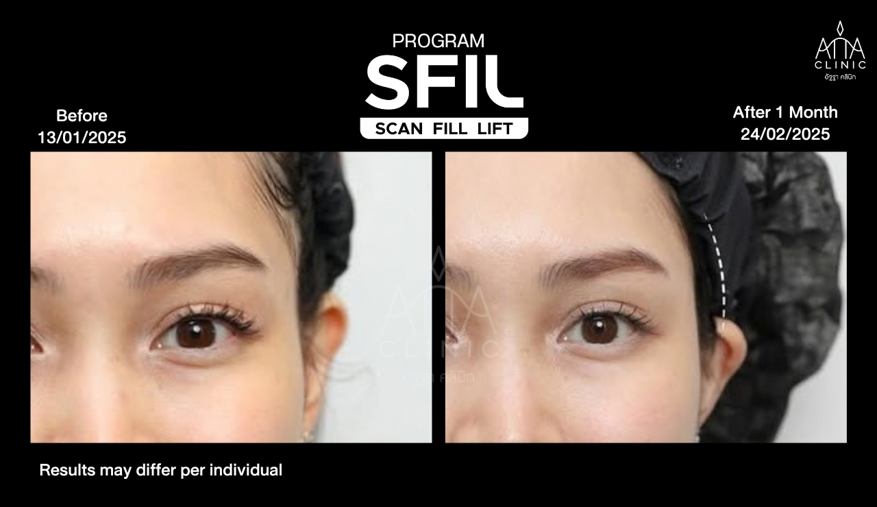 รีวิวฟิลเลอร์โปรแกรม SFIL ก่อนและหลังทำประมาณ 1 เดือน ภาพระยะใกล้เปรียบเทียบบริเวณรอบดวงตา