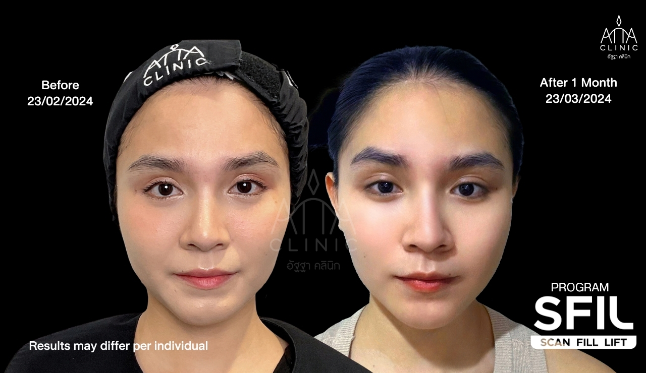 รีวิวฉีดฟิลเลอร์ปรับรูปหน้า โปรแกรม SFIL ก่อนและหลังทำ 1 เดือน เปรียบเทียบใบหน้าและกรอบหน้ามุมตรง