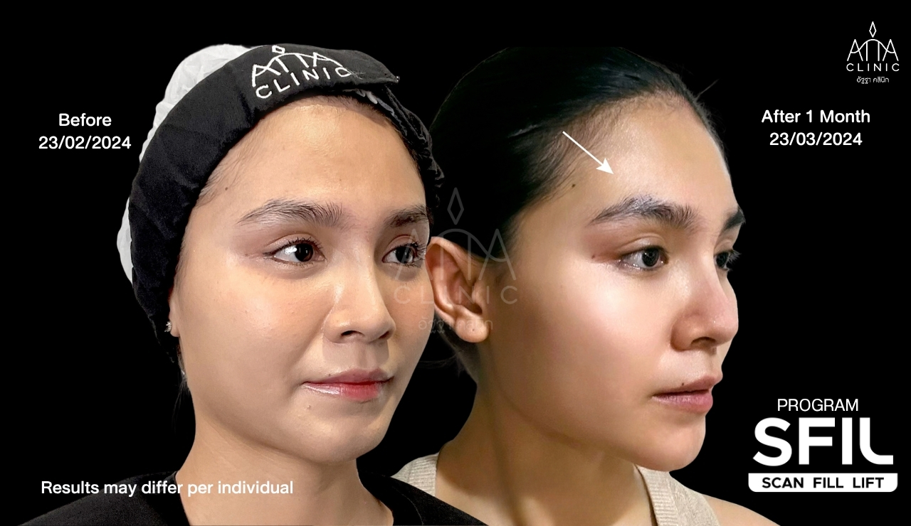 รีวิวฟิลเลอร์ปรับรูปหน้า โปรแกรม SFIL ก่อนและหลังทำ 1 เดือน เปรียบเทียบใบหน้าและบริเวณหน้าผากจากมุมเฉียง