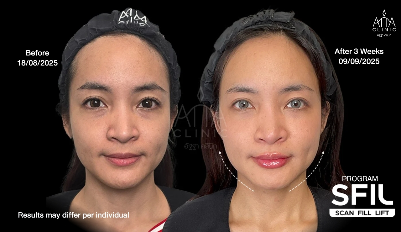รีวิวฉีดฟิลเลอร์ยกกระชับหน้า โปรแกรม SFIL ก่อนและหลังทำ 3 สัปดาห์ เปรียบเทียบใบหน้าและกรอบหน้ามุมตรงที่ ATTA Clinic