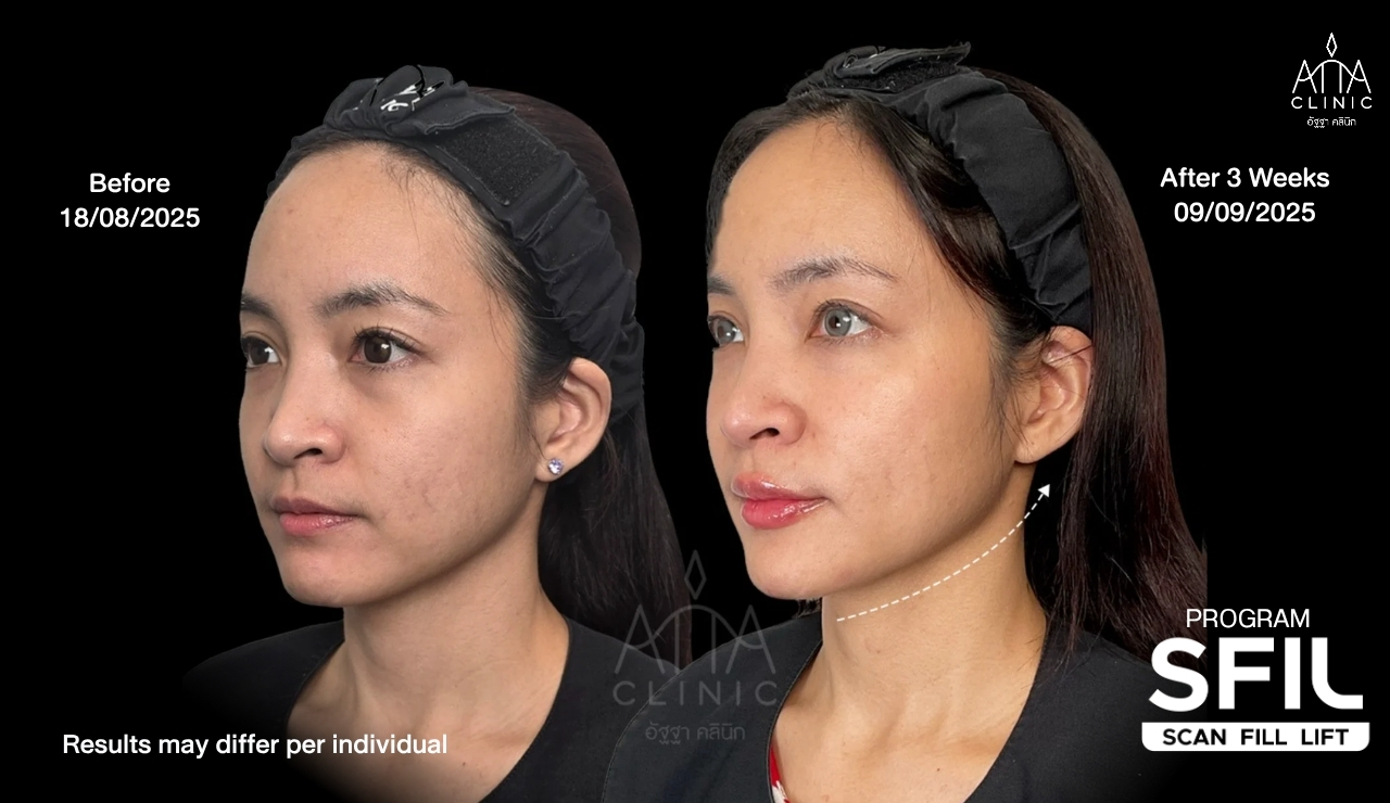 รีวิวฟิลเลอร์ปรับรูปหน้า โปรแกรม SFIL ก่อนและหลังทำ 3 สัปดาห์ เปรียบเทียบบริเวณแก้มและกรอบหน้าจากมุมเฉียง