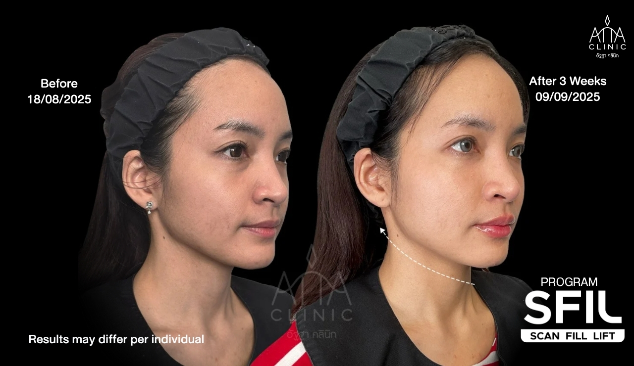 รีวิวฉีดฟิลเลอร์ยกกระชับหน้า SFIL ก่อนและหลังทำ 3 สัปดาห์ เปรียบเทียบรูปหน้าและแนวกรอบหน้าจากมุมเฉียงอีกด้าน