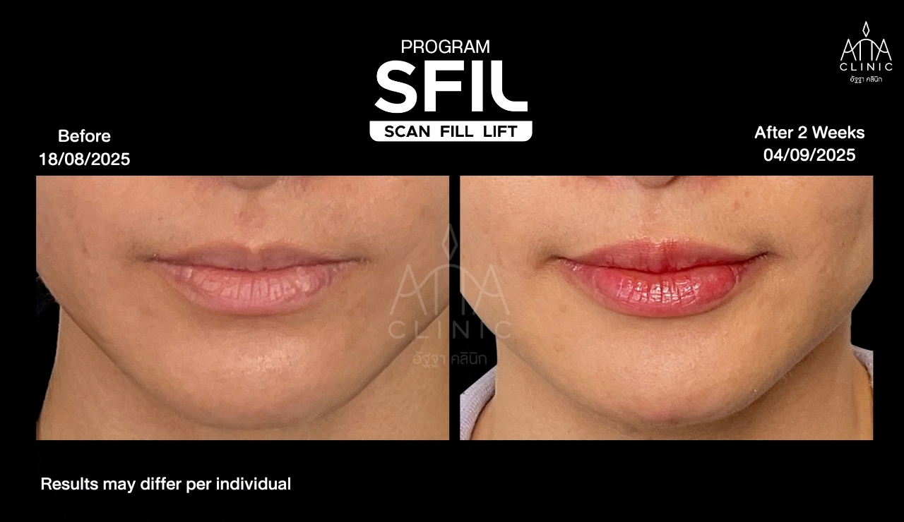 รีวิวฉีดฟิลเลอร์ปาก โปรแกรม SFIL ก่อนและหลังทำ 2 สัปดาห์ เปรียบเทียบรูปทรงริมฝีปากบนและล่างจากมุมตรง