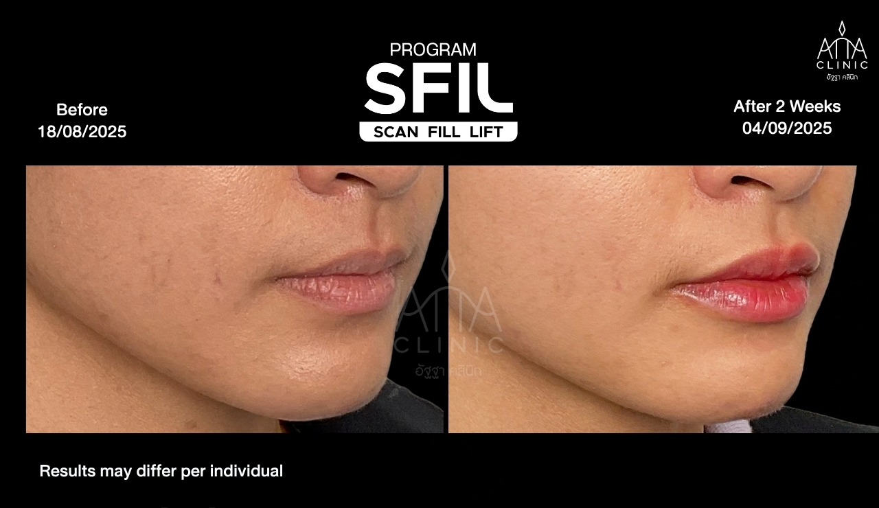 รีวิวฟิลเลอร์ปาก โปรแกรม SFIL ก่อนและหลังทำ 2 สัปดาห์ เปรียบเทียบรูปทรงริมฝีปากจากมุมเฉียง