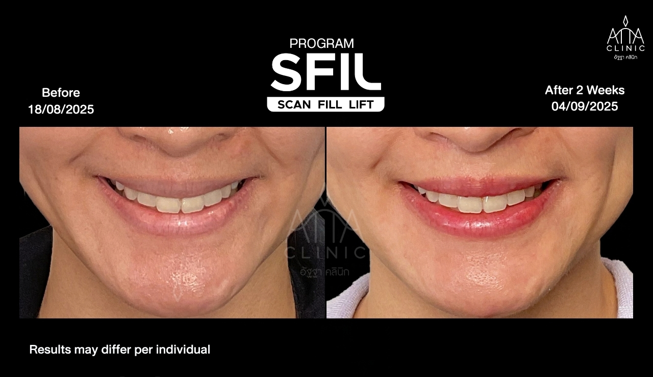 รีวิวฉีดฟิลเลอร์ปาก SFIL ก่อนและหลังทำ 2 สัปดาห์ ภาพระยะใกล้เปรียบเทียบรูปทรงริมฝีปากขณะยิ้ม