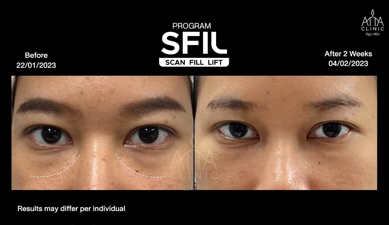 รีวิวฟิลเลอร์ใต้ตา โปรแกรม SFIL ก่อนและหลังทำ 2 สัปดาห์ เปรียบเทียบบริเวณใต้ตาทั้งสองข้างจากมุมตรง