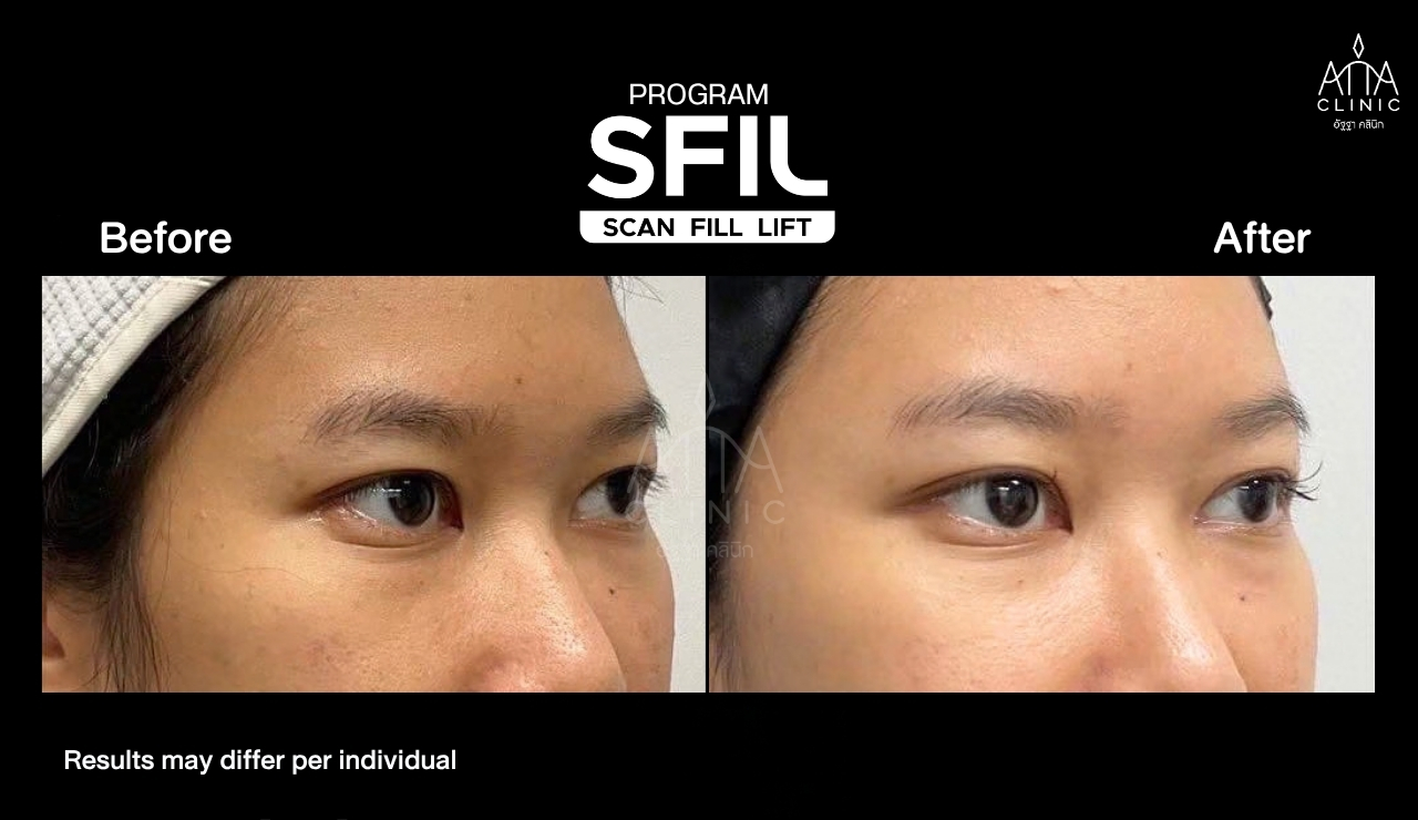 รีวิวฉีดฟิลเลอร์ใต้ตา SFIL ก่อนและหลังทำ ภาพระยะใกล้เปรียบเทียบบริเวณใต้ตาจากมุมเฉียงที่ ATTA Clinic