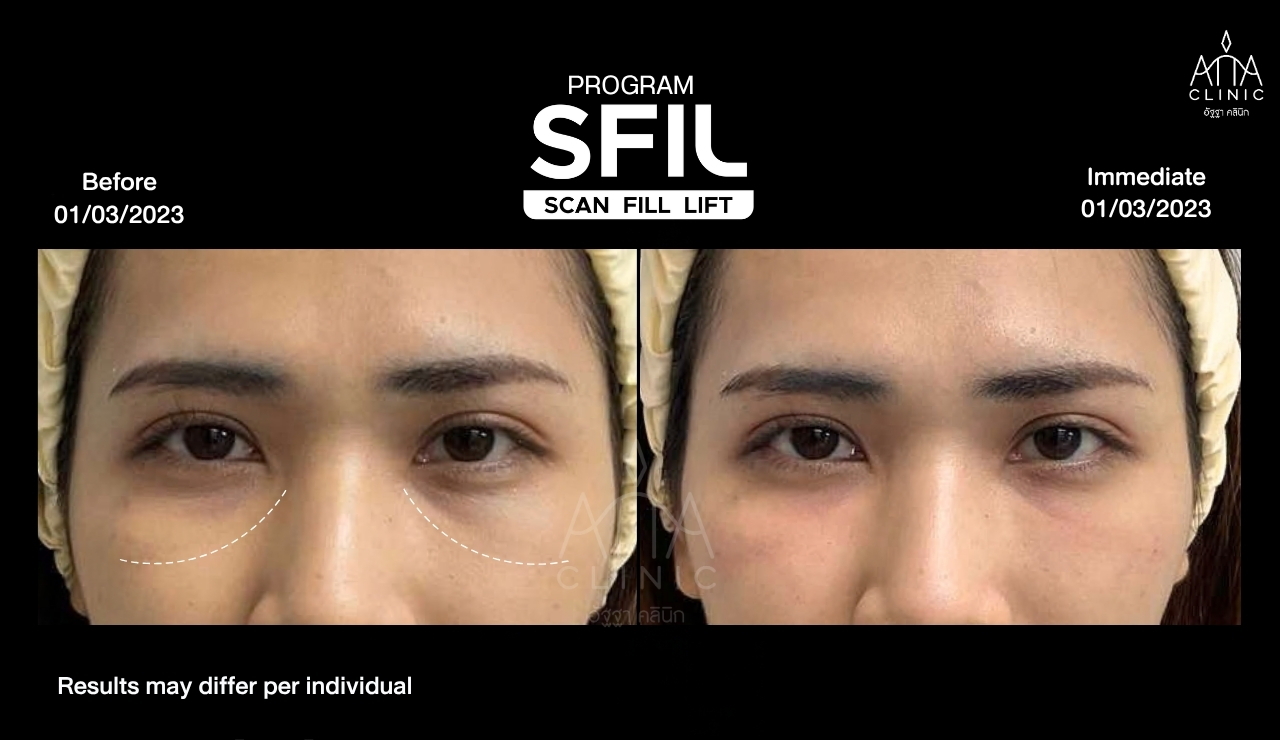 รีวิวฟิลเลอร์ใต้ตา โปรแกรม SFIL ก่อนและหลังทำทันที เปรียบเทียบบริเวณใต้ตาทั้งสองข้างจากมุมตรง