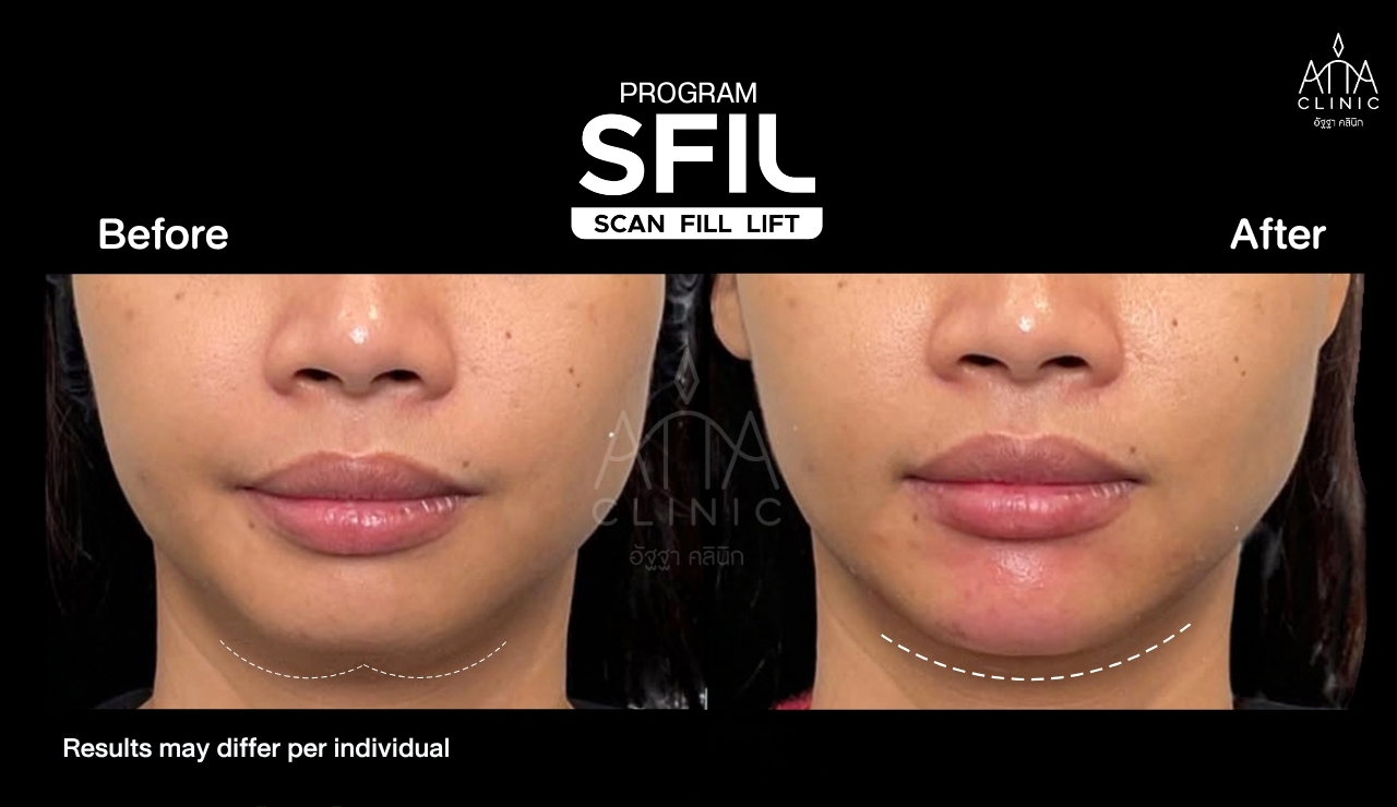 รีวิวฉีดฟิลเลอร์ปรับรูปหน้า โปรแกรม SFIL ก่อนและหลังทำ เปรียบเทียบบริเวณปาก คาง และใบหน้าส่วนล่างจากมุมตรง