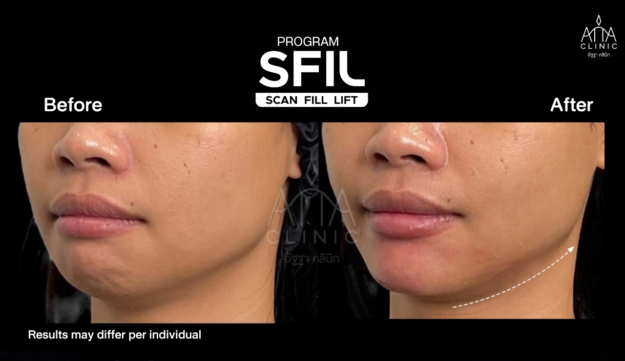 รีวิวฟิลเลอร์ปรับรูปหน้า โปรแกรม SFIL ก่อนและหลังทำ เปรียบเทียบบริเวณคางและแนวกรอบหน้าจากมุมเฉียง