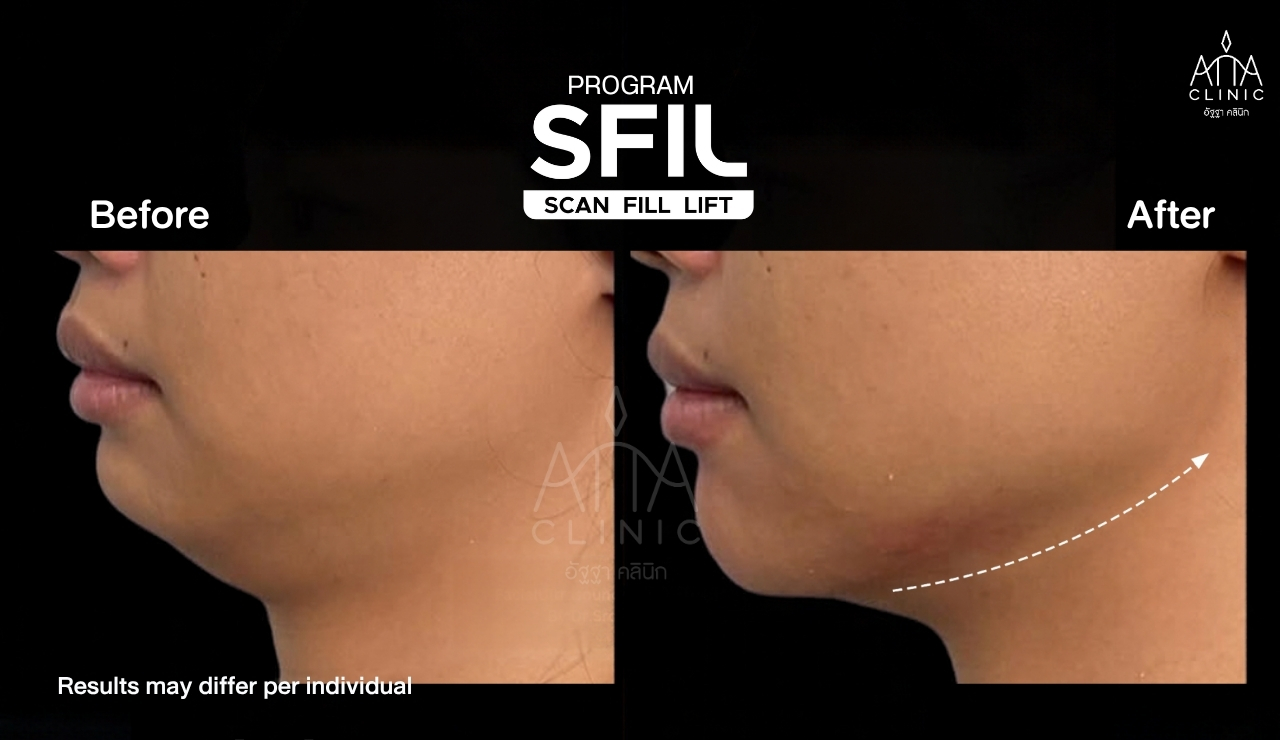 รีวิวฟิลเลอร์ปรับกรอบหน้า โปรแกรม SFIL ก่อนและหลังทำ เปรียบเทียบบริเวณคางและใต้คางจากมุมด้านข้าง