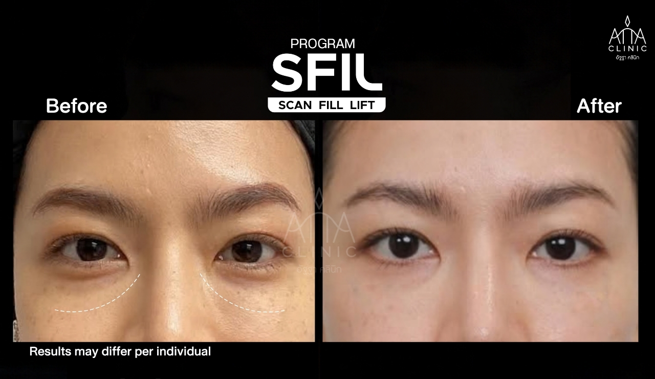 รีวิวฉีดฟิลเลอร์ใต้ตา โปรแกรม SFIL ก่อนและหลังทำ เปรียบเทียบบริเวณใต้ตาทั้งสองข้างจากมุมตรง
