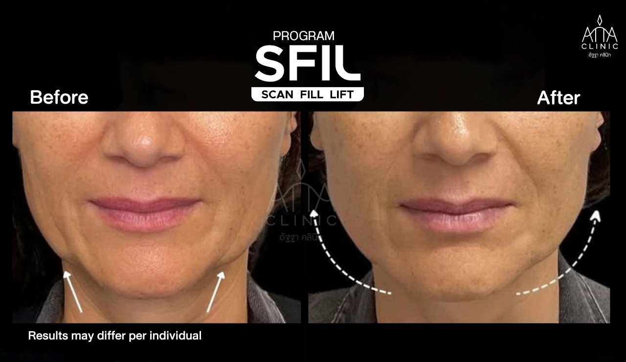รีวิวฟิลเลอร์ยกกระชับหน้า โปรแกรม SFIL ก่อนและหลังทำ เปรียบเทียบบริเวณแก้ม ร่องแก้ม และกรอบหน้ามุมตรง