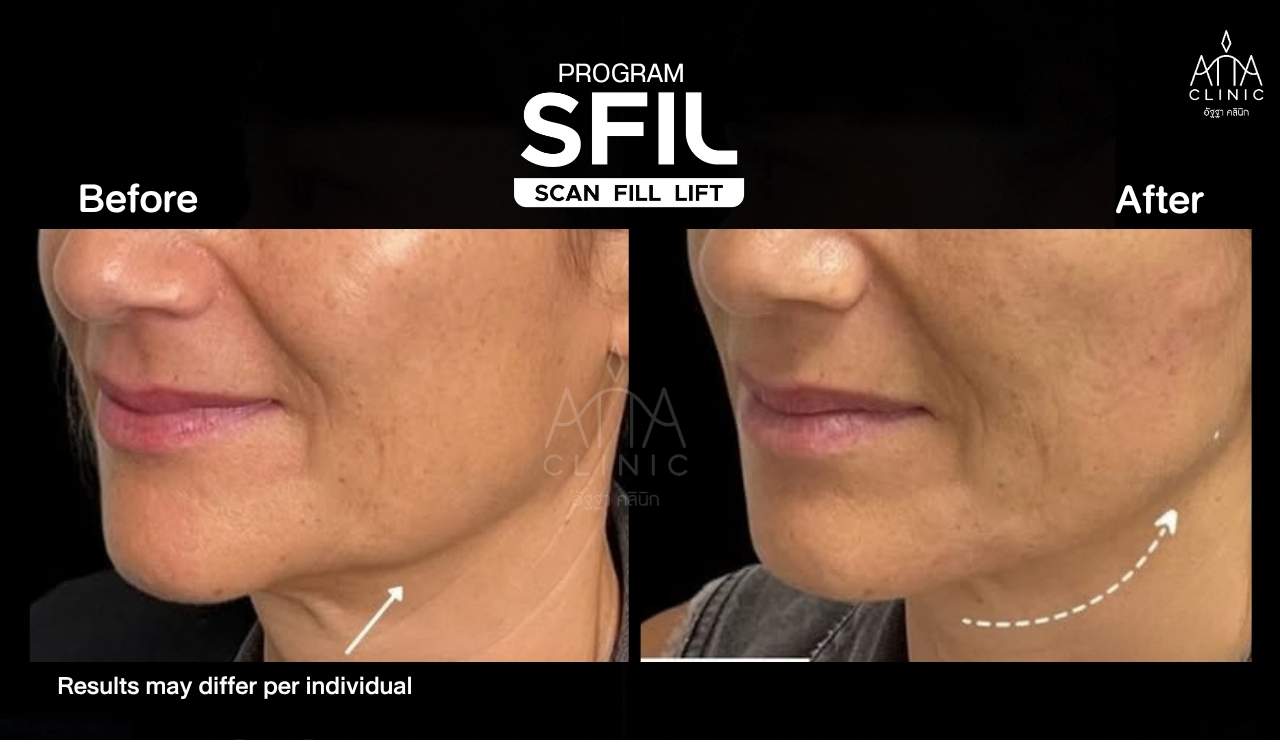 รีวิวฉีดฟิลเลอร์ปรับรูปหน้า โปรแกรม SFIL ก่อนและหลังทำ เปรียบเทียบบริเวณร่องแก้มและกรอบหน้าจากมุมเฉียง