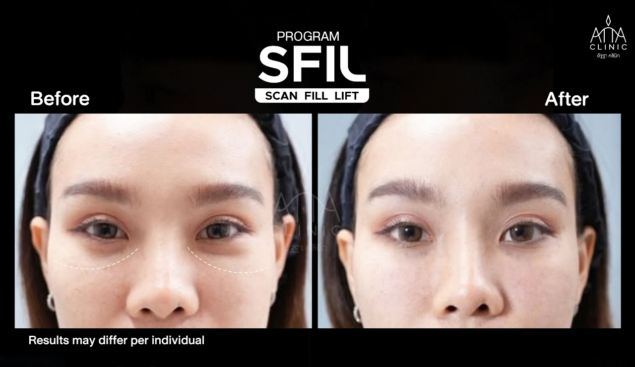 รีวิวฟิลเลอร์ใต้ตา โปรแกรม SFIL ก่อนและหลังทำ ภาพระยะใกล้เปรียบเทียบบริเวณใต้ตาทั้งสองข้าง