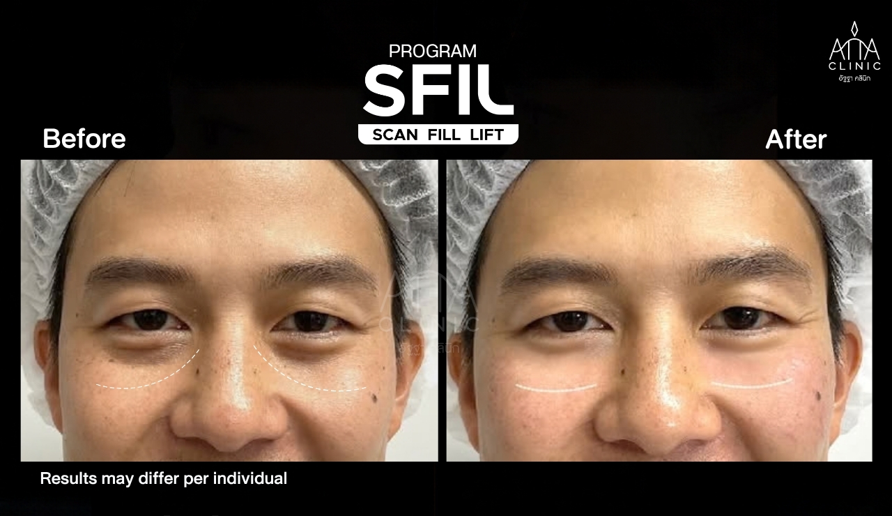 รีวิวฉีดฟิลเลอร์ใต้ตา SFIL ก่อนและหลังทำ ภาพระยะใกล้เปรียบเทียบบริเวณใต้ตาขณะยิ้ม