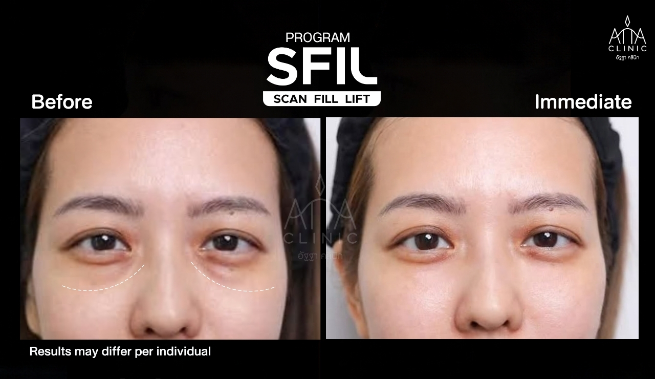 รีวิวฟิลเลอร์ใต้ตา โปรแกรม SFIL ก่อนและหลังทำทันที เปรียบเทียบบริเวณใต้ตาจากมุมตรงที่ ATTA Clinic