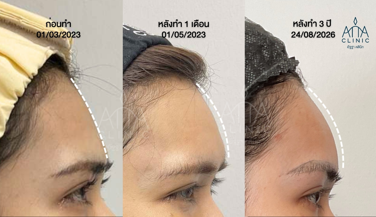 รีวิวฟิลเลอร์หน้าผาก โปรแกรม SFIL เปรียบเทียบรูปทรงหน้าผากก่อนทำ หลังทำ 1 เดือน และภาพติดตามผลประมาณ 3 ปี