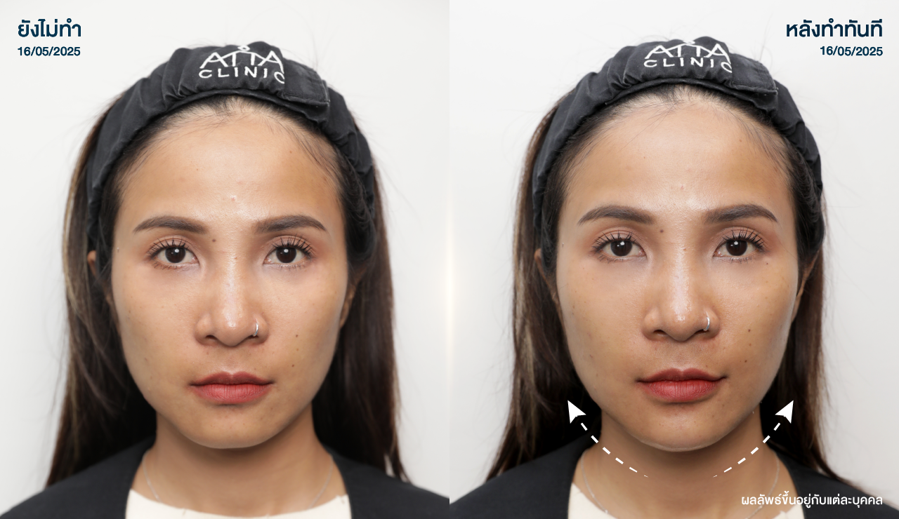 ATTA_BEFORE_AFTER_BANNER_1280x740PX-10