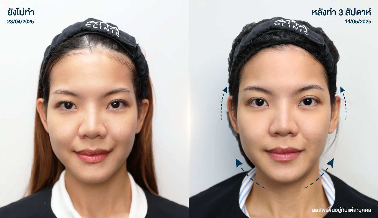 ATTA_BEFORE_AFTER_BANNER_1280x740PX-11