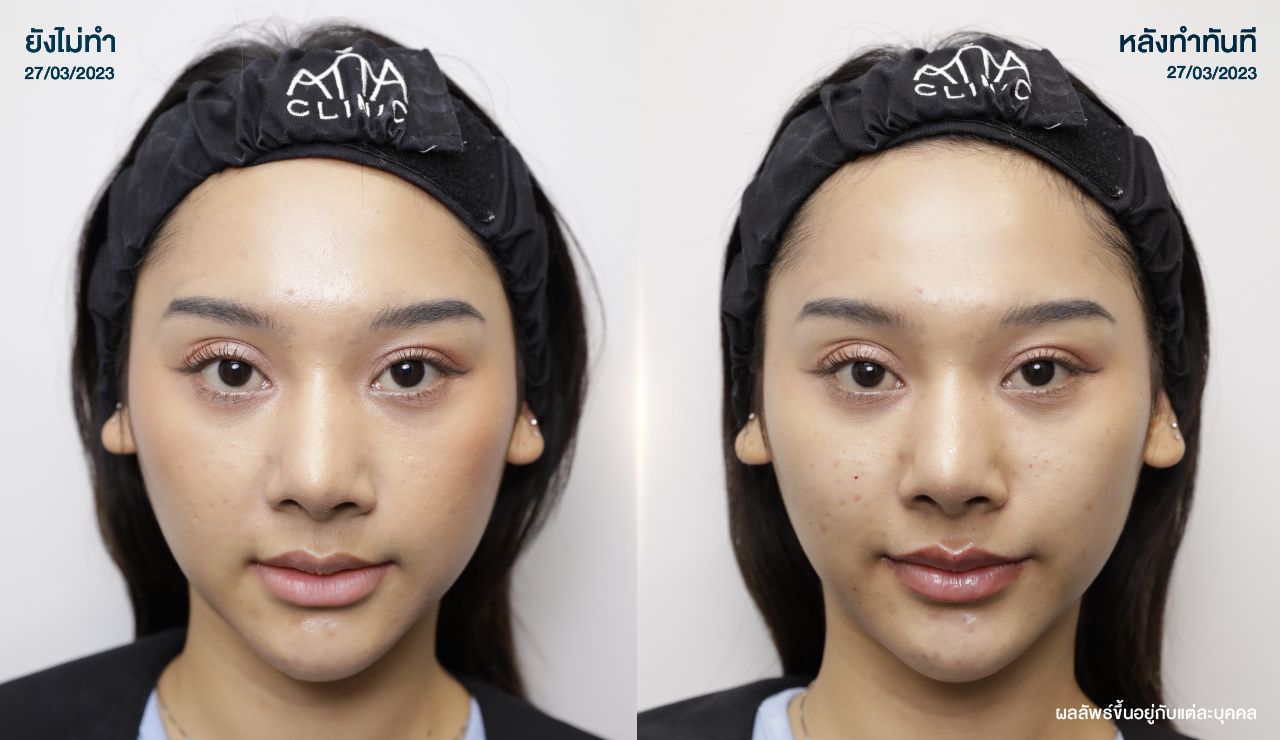 ATTA_BEFORE_AFTER_BANNER_1280x740PX-13-13