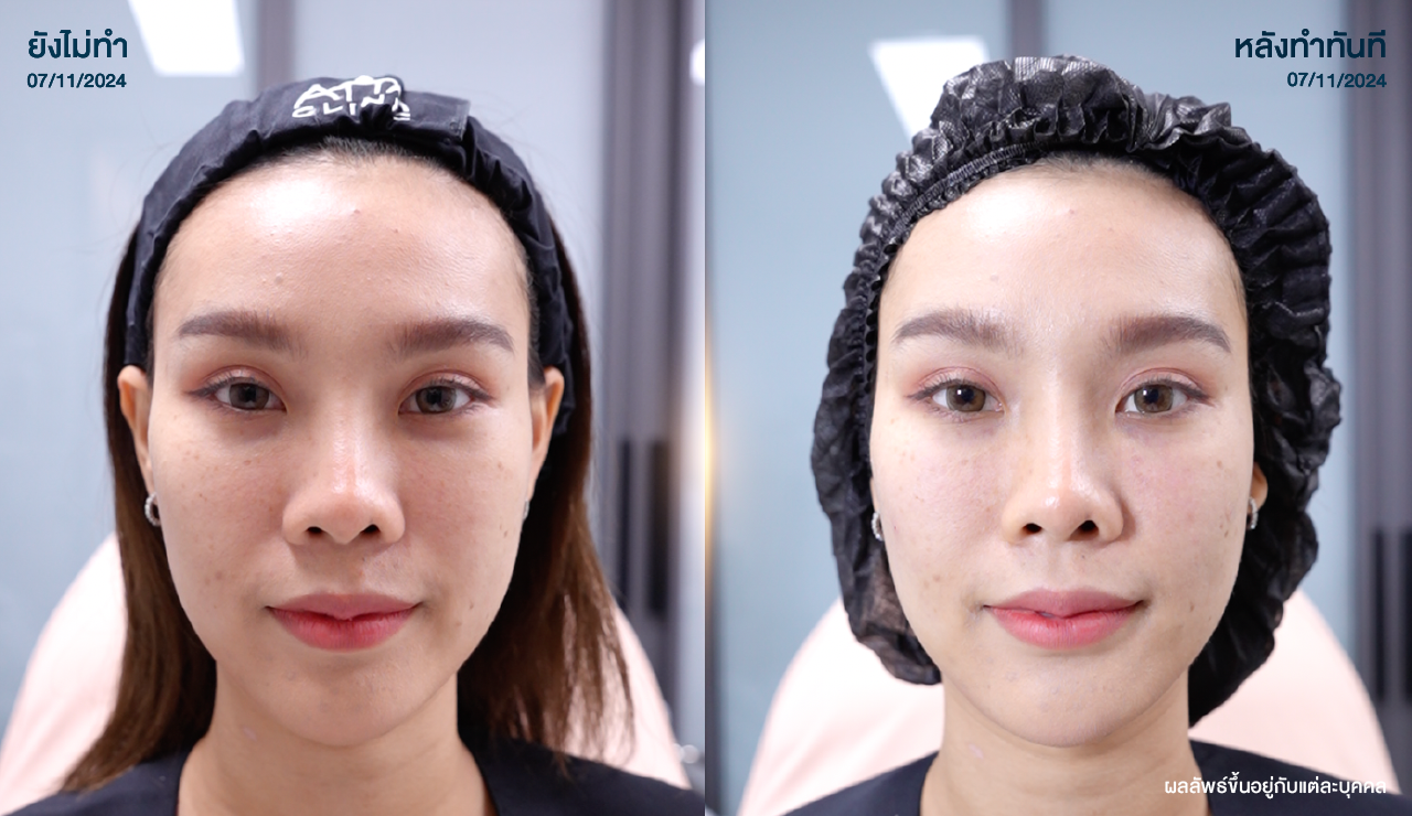 ATTA_BEFORE_AFTER_BANNER_1280x740PX-14