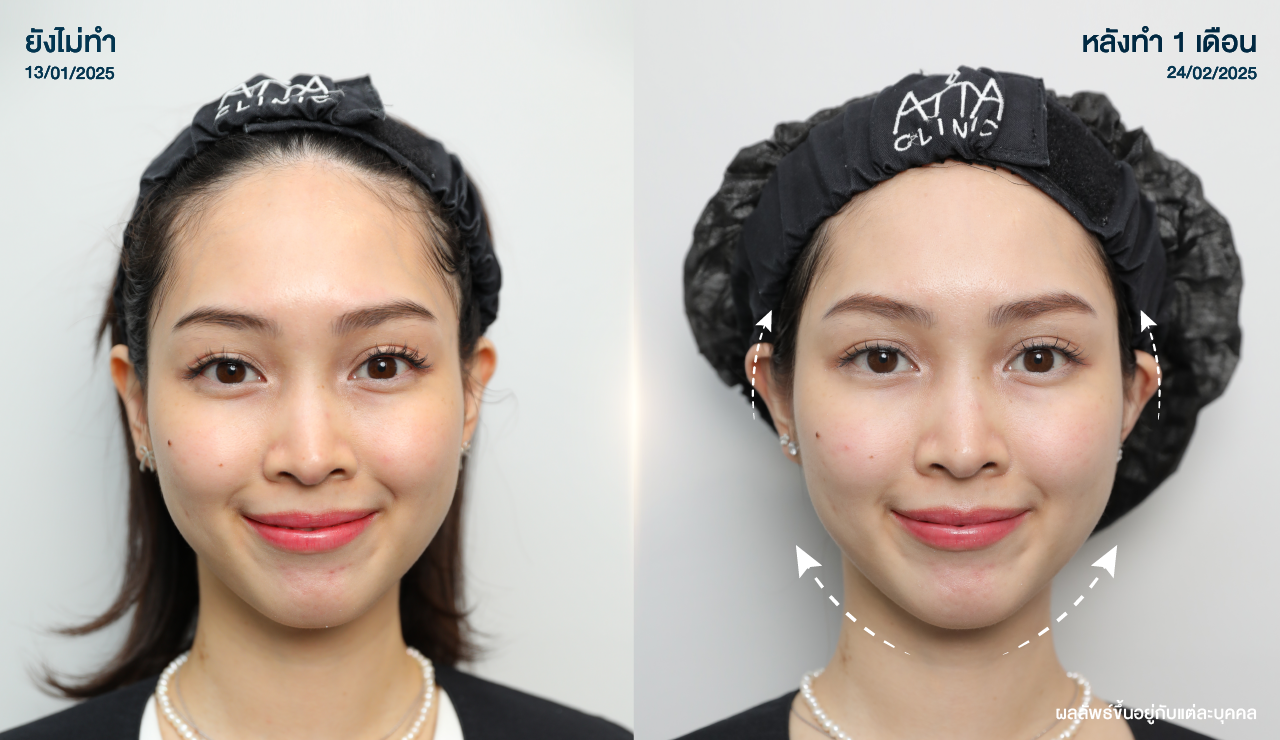 ATTA_BEFORE_AFTER_BANNER_1280x740PX