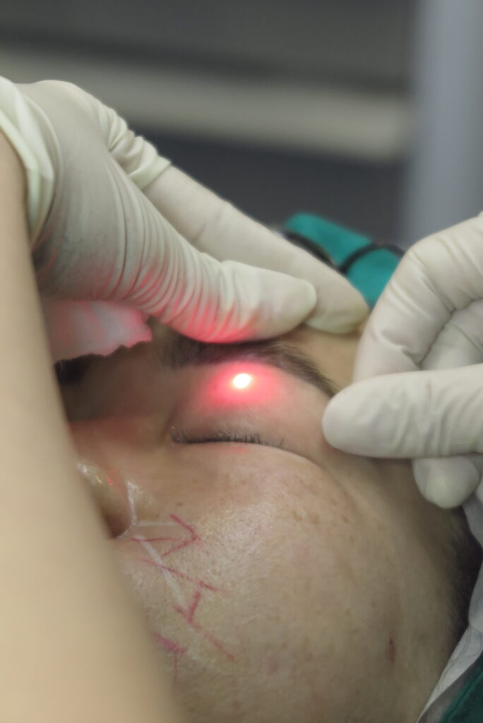 EndoliftX with Facial Ultrasound in Thailand